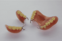 バネ式入れ歯の問題点