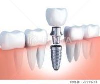 歯周病で歯が抜けてインプラントをしようと考えている方へ