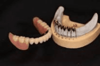 テレスコープ義歯（ドイツ式入れ歯）に問題点はないの？