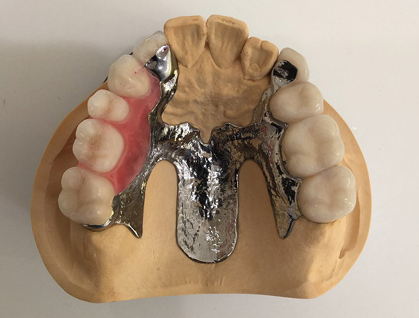 ケース2：八重歯の矯正治療を行い、ドイツ式入れ歯（テレスコープ義歯、コーヌステレスコープ）で治療