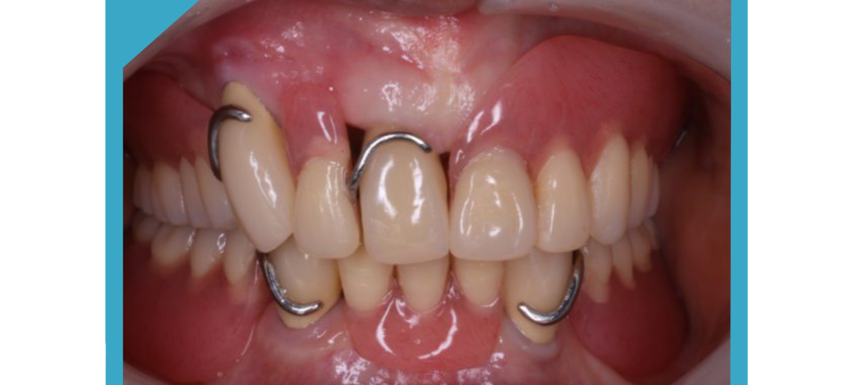 多くの方が抱えているお悩み「バネが見える入れ歯はいや」を解決します