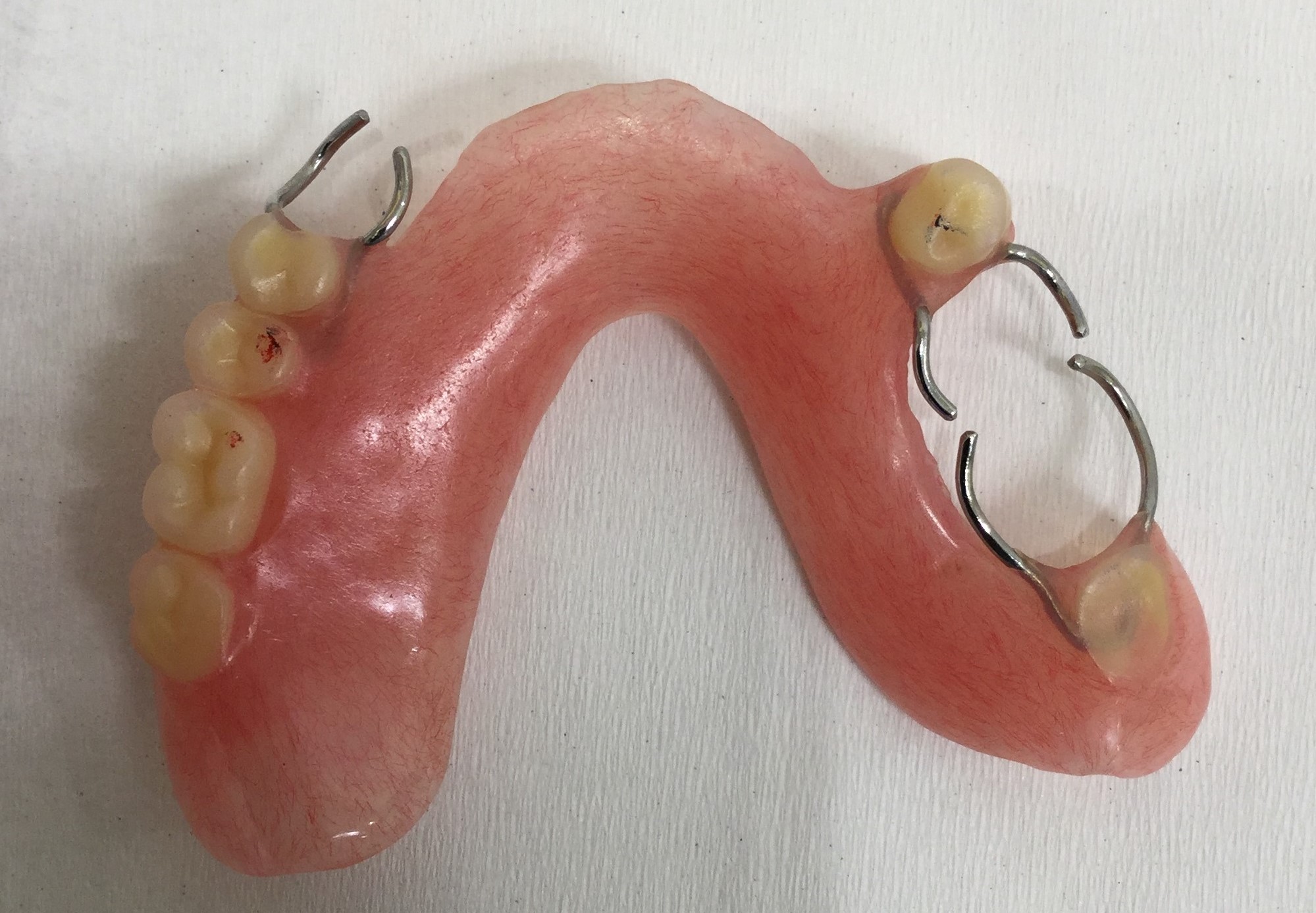 ドイツ式入れ歯と保険適用のバネ式入れ歯の比較