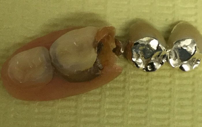 ドイツ式入れ歯の修理